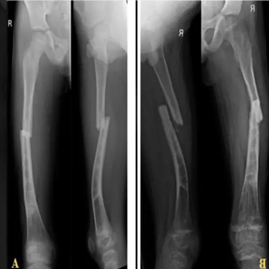 x-ray both thigh/femur ap/lat view